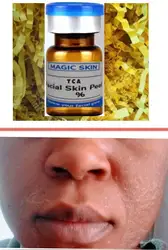 TCA 20% 30% 40% 50% 60% 70% 90% 100% Solução Esfoliante FACIAL PEELING PEELING QUÍMICO