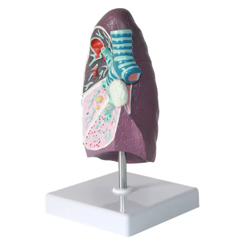 Medical Human Pathological Pulmonary Model Medical Model Pulmonary Anatomy Model Respiratory System Model Teaching Supplies