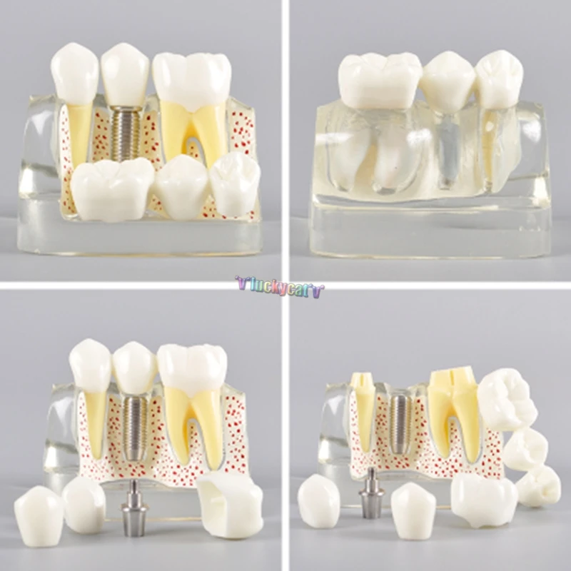 1Pc Dental Teach Implant Analysis Crown Bridge Removable Model Dental Demonstration Teeth Model