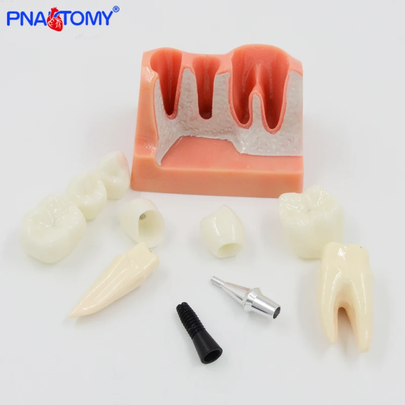 Removable Dental Teeth Implant Restoration Model Pathological Implant Nerve Model For Dental Disease Analysis Demonstration Tool