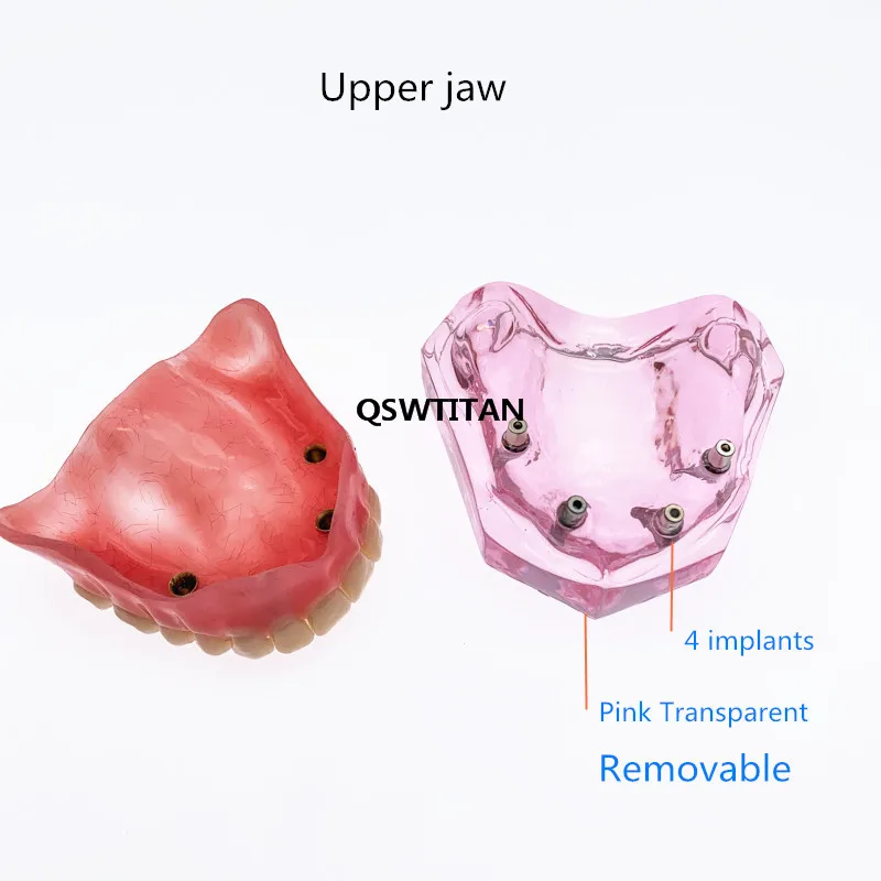 Dental Overdenture Superior With Implants Demo Model Teeth Model For Student Dentists