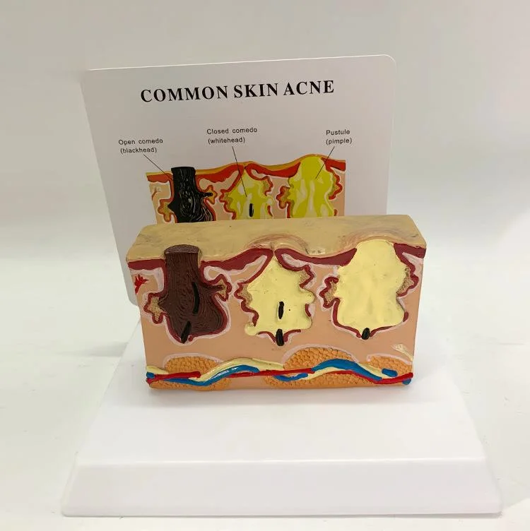 Common Skin Acne Enlarge Skin Structure Anatomical Model Tissue Hierarchical  Micro Plastic Surgery Suture Beauty Teaching