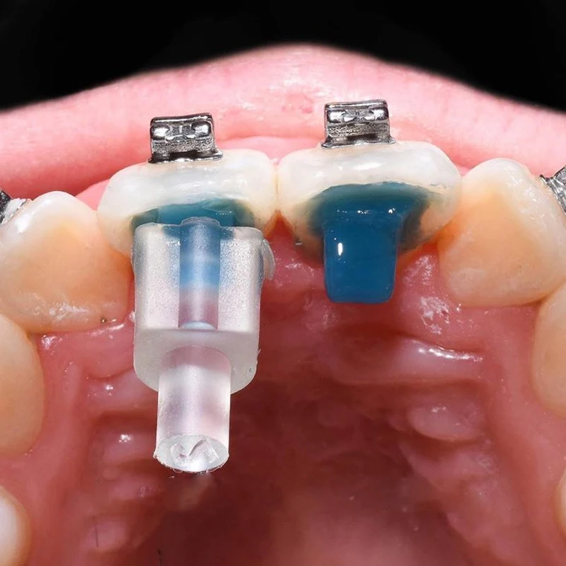 Dental Orthodontic Mini Mold Bite Ramp Forms Lingual Button Traction Hook Injection Mould Blue Adhesive Bonding Glue Brackets