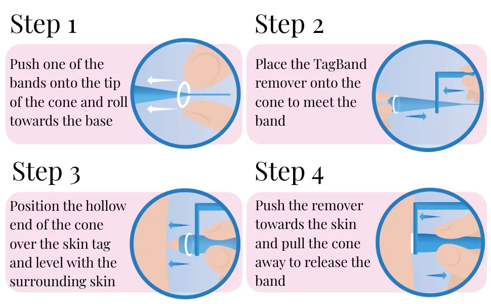 Herramienta de eliminación de papiloma para el cuidado de la cara, Kit de microbanda azul, removedor de etiquetas de piel, maíz con hisopos de limpieza, verruga de Topo