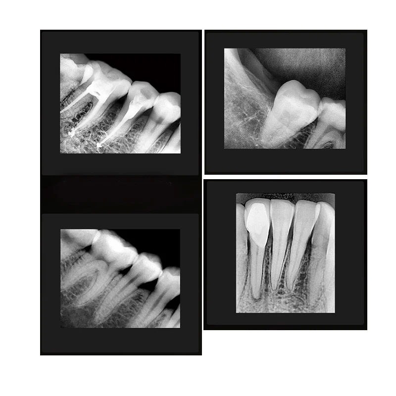 Digital Dental X-ray Sensor High Definition Intraoral Imaging System Medical Dentist Equipment