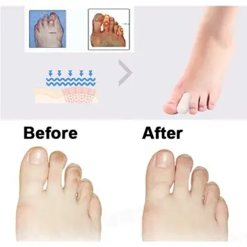 Silikon Big Toe Protector Fuß Schwielen Hühneraugen Blister Schutzpolster Anti Reibung Fingerschutz Hallux Valgus Separator