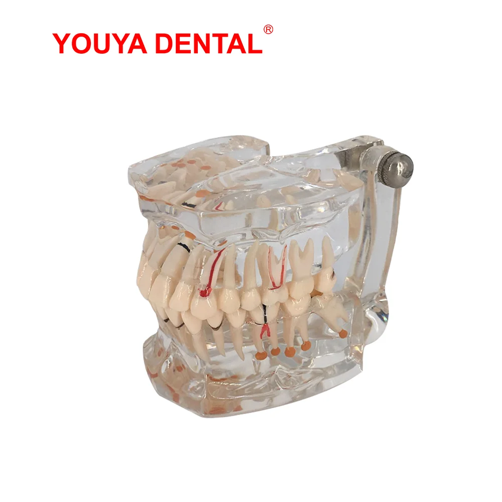 1pcs Transparent Dental Model Teeth Restoration Bridge Tooth Implant Model For Studying Teaching Medical Science  Detal Products