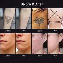 Laser Picosecond Pen for Tattoo and Pigment Removal #4