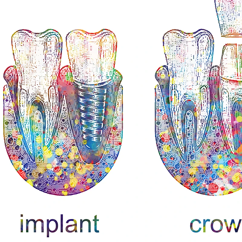 Tooth Implant Art Dental Crown Print Dentist Gift Tooth Anatomy Medical Wall Art Canvas Painting Picture Dental Clinic Decor