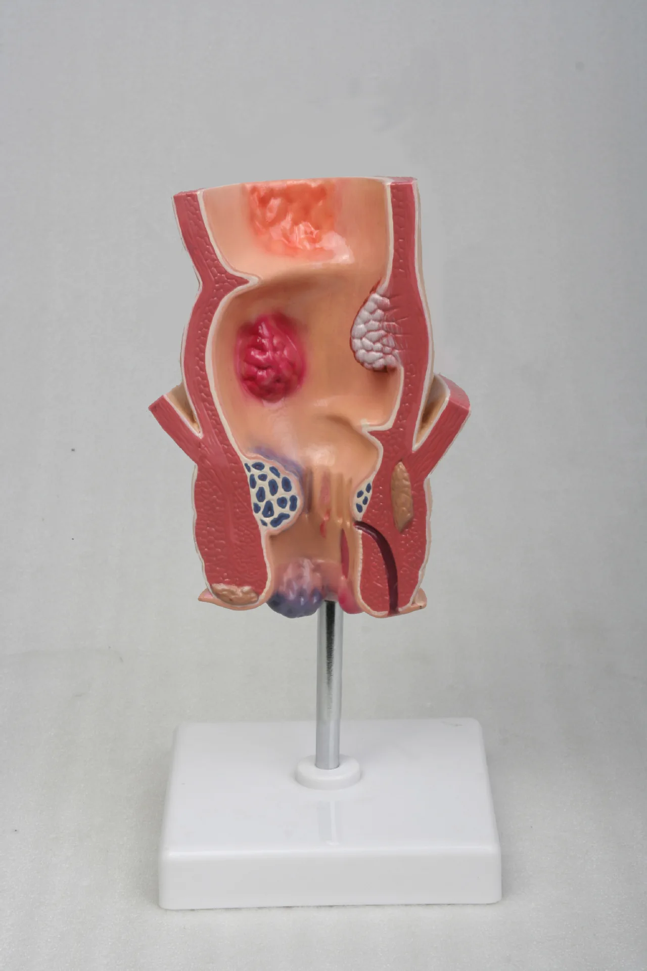 5 Times Human Anatomy  Rectal Hemorrhoids Lesion Model Internal Hemorrhoids Anal Model Anatomy