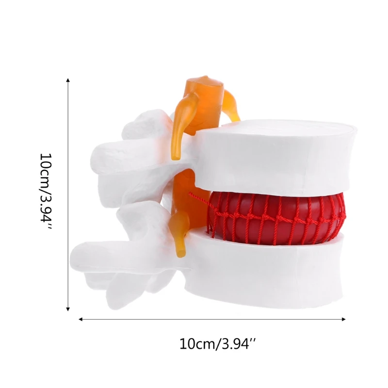 Lumbar Vertebral Model of Human Lumbar Intervertebral Disc Herniation Demonstration Model