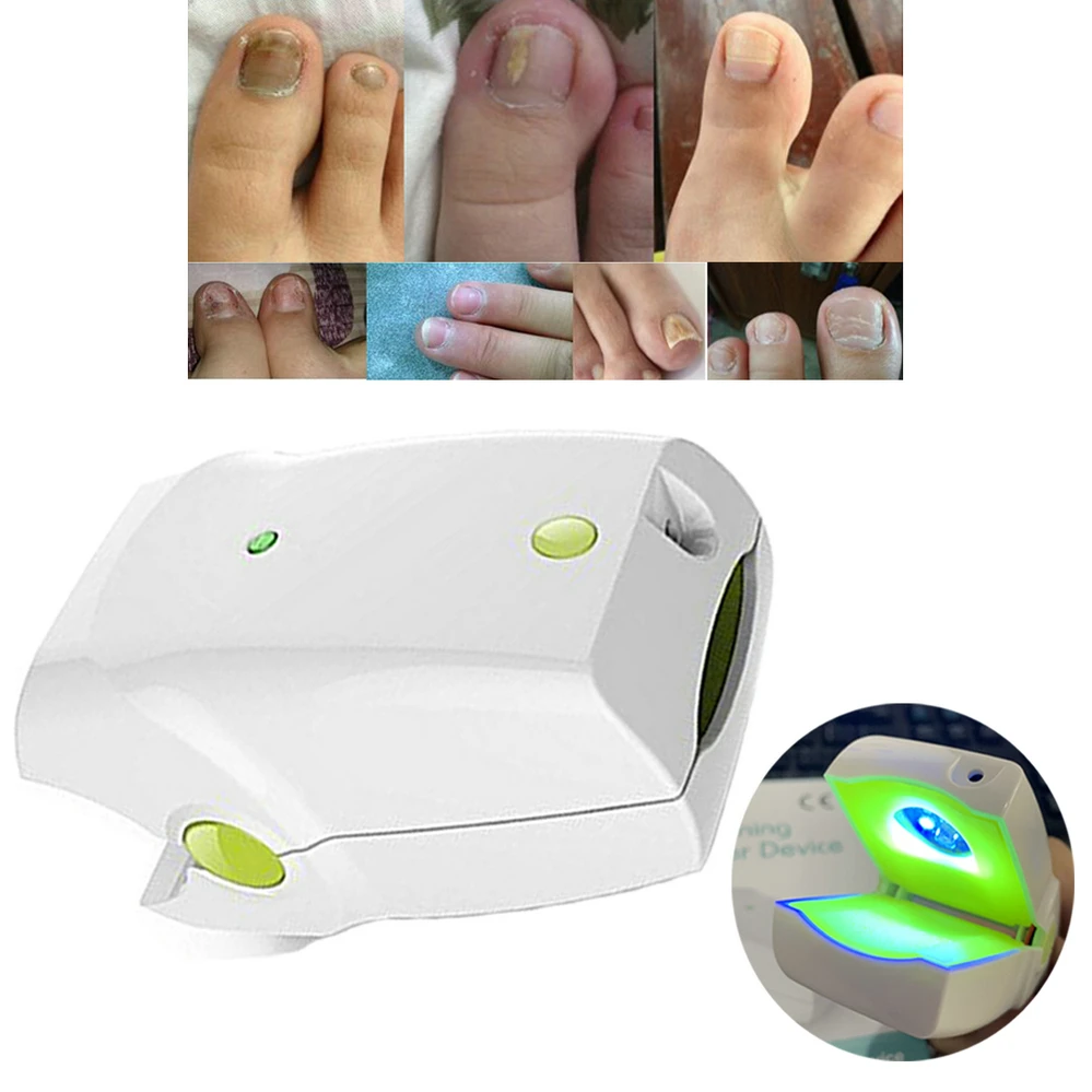 NEW Home Use Toe Nail Fungus Laser Light Therapy Device Onychomycosis Anti Toenail Fungal Infection LLLT Physiotherapy