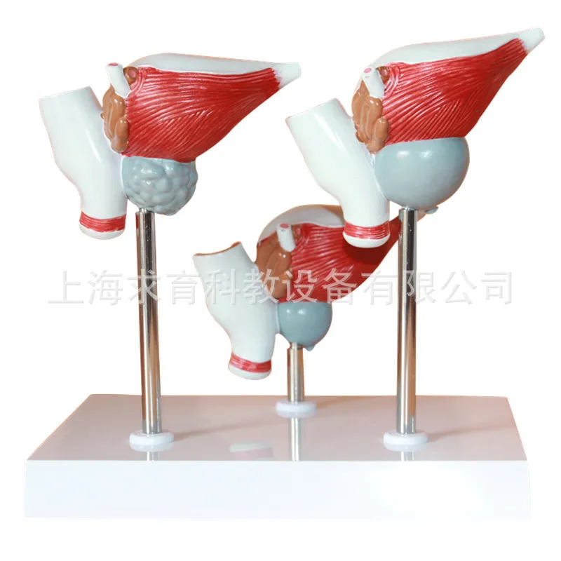 3pcs/set Normal Prostate Benign Prostatic Hypertrophy (BPH) with Or Without Symptoms and Cancer Model Medical Supplies