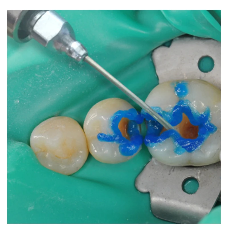Dental Suction Endo Irrigation Dental Aspirator Screw type Surgical Root Canal Irrigation Saliva Ejectors 1Set