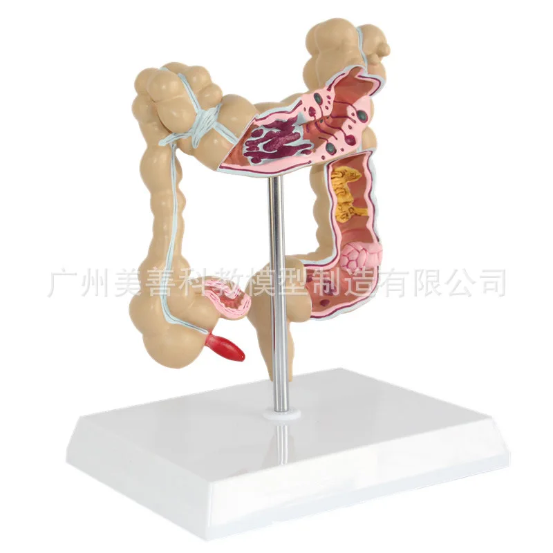 1/2 Life Size Human Rectal Pathology Colon Model Large Intestine Model Anorectal Anatomical Model Tools