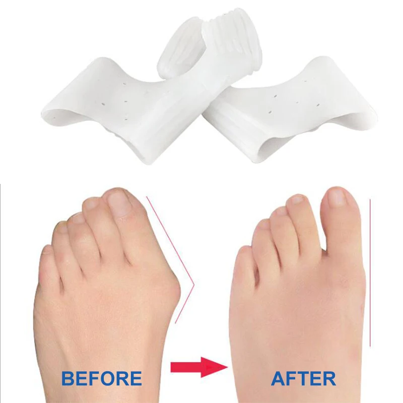 2Pcs Teen Orthopedische Bunion Siliconen Gel Duim Afscheiders Spacers Hallux Valgus Corrector Bretels Tenen Pedicura Voetverzorging Tool