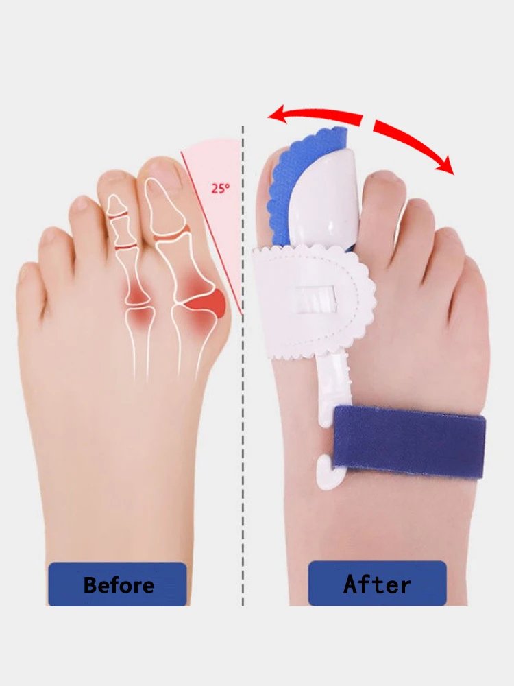 2Pcs Toe Separator Hallux Valgus Corrector  Toe Corrector  Bunions  Finger Separator Haluksy Separator For Toes Bunion Corrector