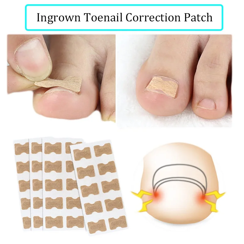 

100Pieces Non-glue Correcting Toenail Patch Tape Non-woven Ingrown Toenail Correction Patch Nail Valgus Prevention Sticker