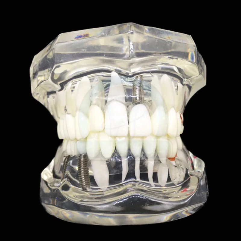 

Dental Teaching Study Model Restoration Tooth Model Implant Disease Teeth Model with Bridge Detachable Teeth Disease