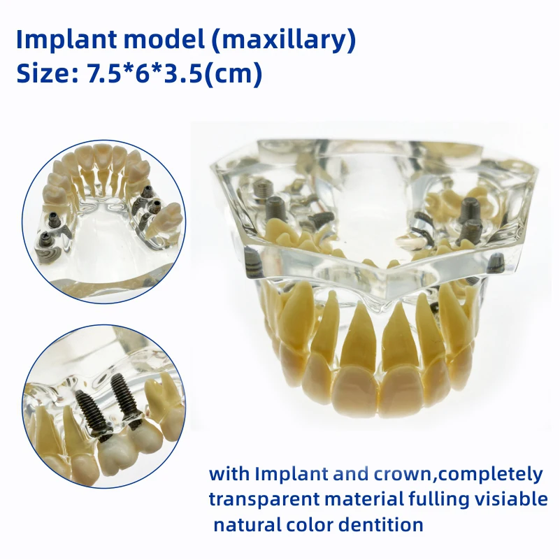 

Dental Upper/Lower Implant model with bridge and caries implant Mandibular Teeth