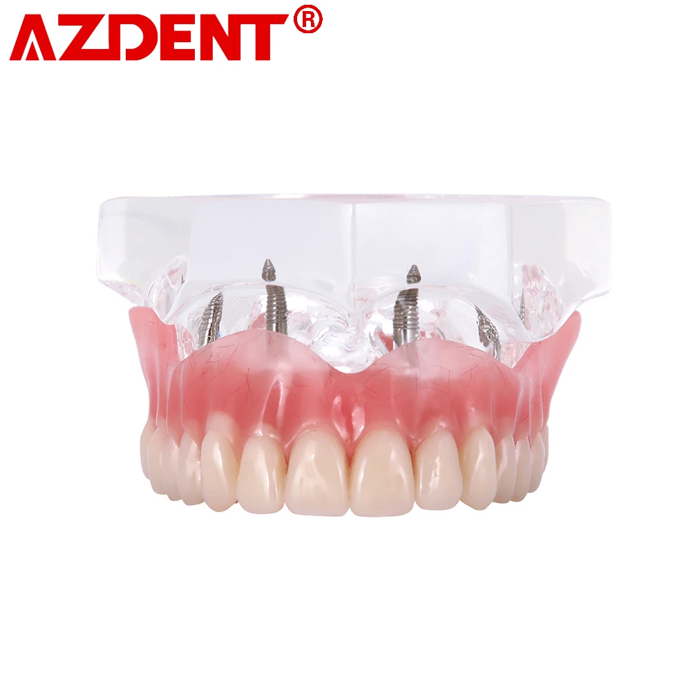 Dental Overdenture Teeth Dental Implant Teeth Model Demo Overdenture Restoration With Implants upper