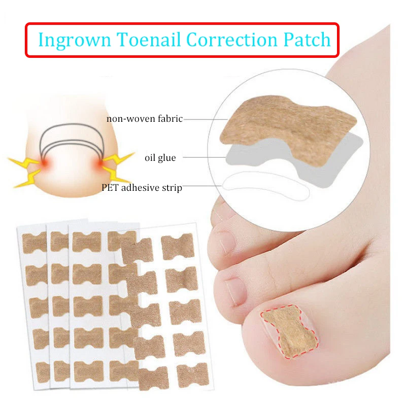 10/30/50/60Pieces Ingrown Toenail Correction Sticker Nail Ingrowing Correction Patch Paronychia Corrector Pedicure Tools