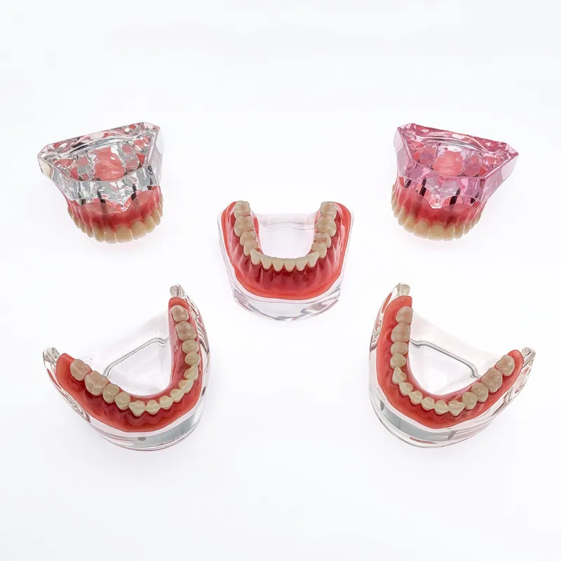 Dental Overdenture Superior With Implants Demo Model Teeth Model For Student Dentists