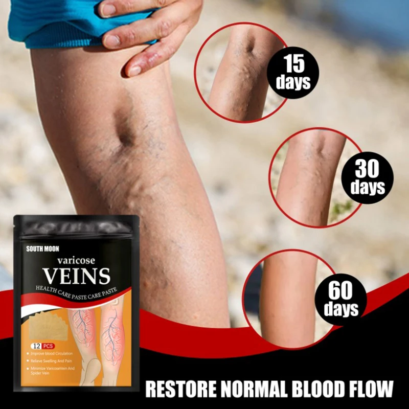 12Pcs Herbal Varicose Veins Detox Healing Patch Vasculitis Phlebitis Spider Patch Varicosity Angiitis Removal Medical Plaster