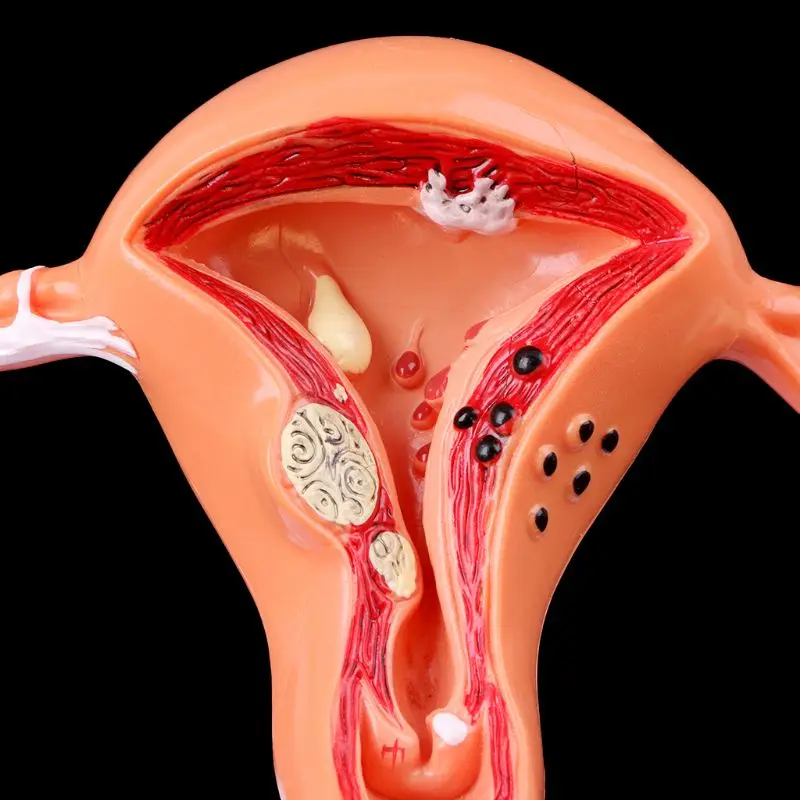 Medizinische requisiten modell Freies porto Pathologischen Gebärmutter Eierstock Anatomisches Modell Anatomie Kreuz Abschnitt Studie Werkzeug