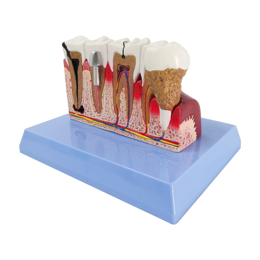 Dental Model | Human Body Anatomy Replica of Teeth w/Common Pathologies for Dentist Office Educational Tool