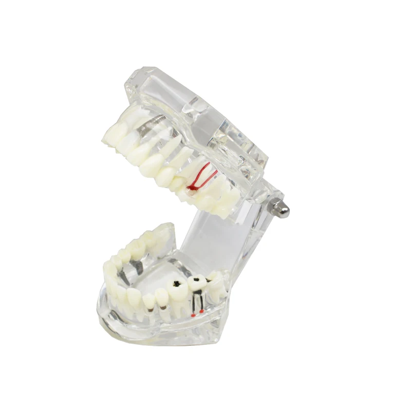 2pcs Dental Model teeth implant Restoration Bridge Teaching Study Tooth Medical Science Disease Study Dentist Dentistry products