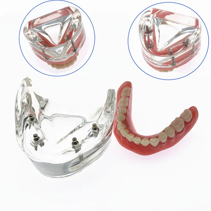 Model zębów dentystycznych z implantem Overdenture gorszy model zębów żuchwowych Model badania