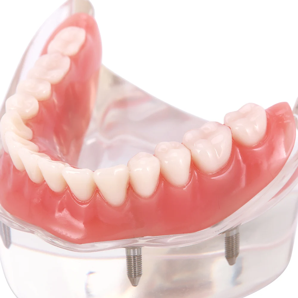 Dental Overdenture zęby Model nauczania zdejmowane wnętrze żuchwa z implantem tylko do celów demonstracyjnych