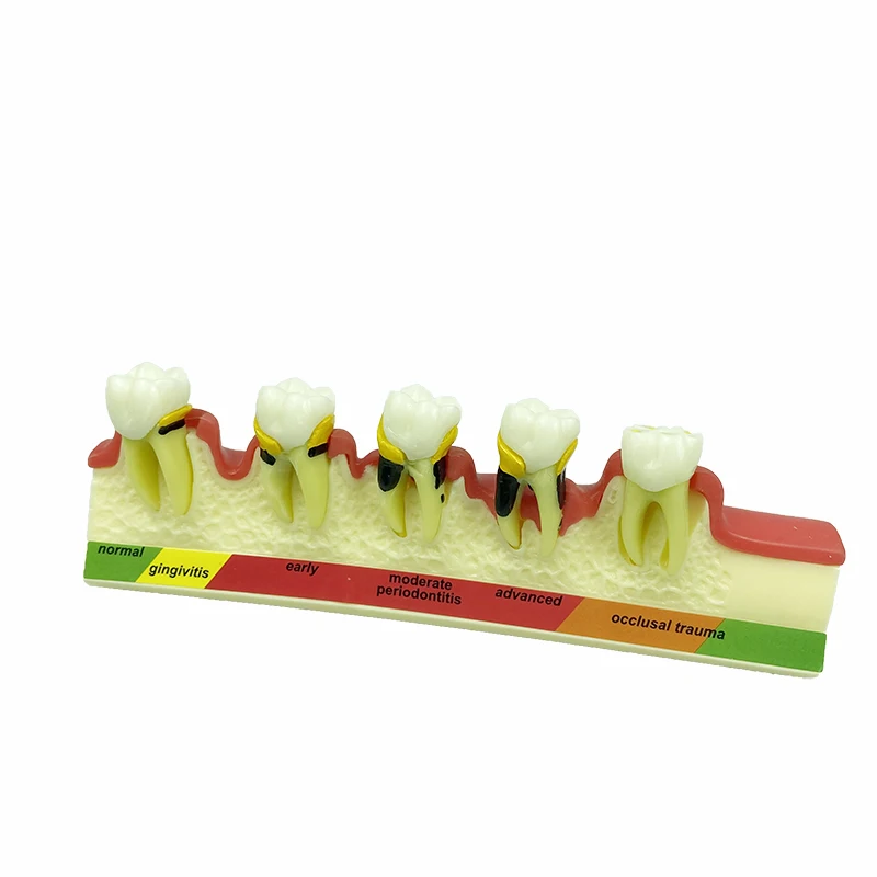 

Dental Periodontal Disease Dentoform Typodont Dental Standard Teeth Model Dental Education Model