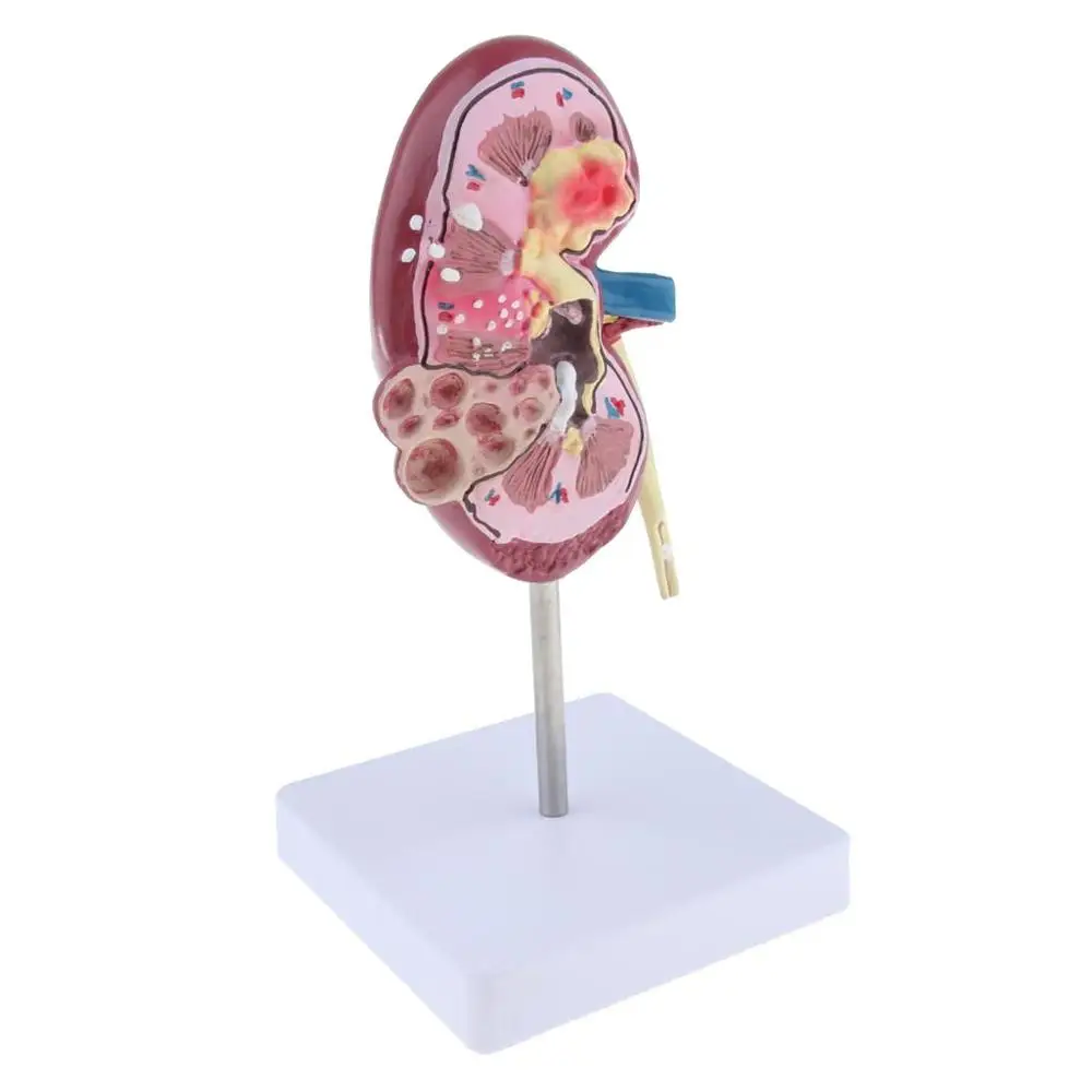 Kidney Human  Anatomical Model 2Sided, Normal and with Pathologies