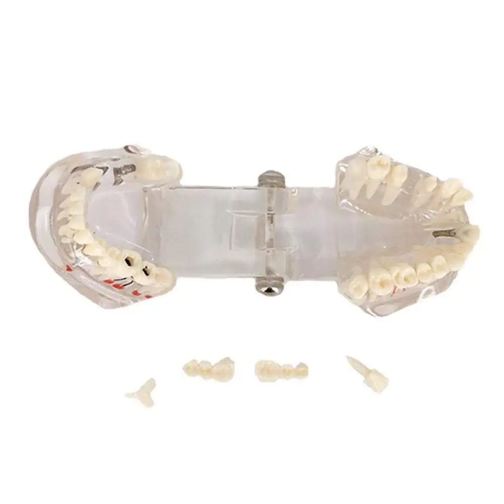 Dentistry Implant Dental Models For Patient Education Communication Dentist Medical Science Macro  Teeth Model Studying Teaching