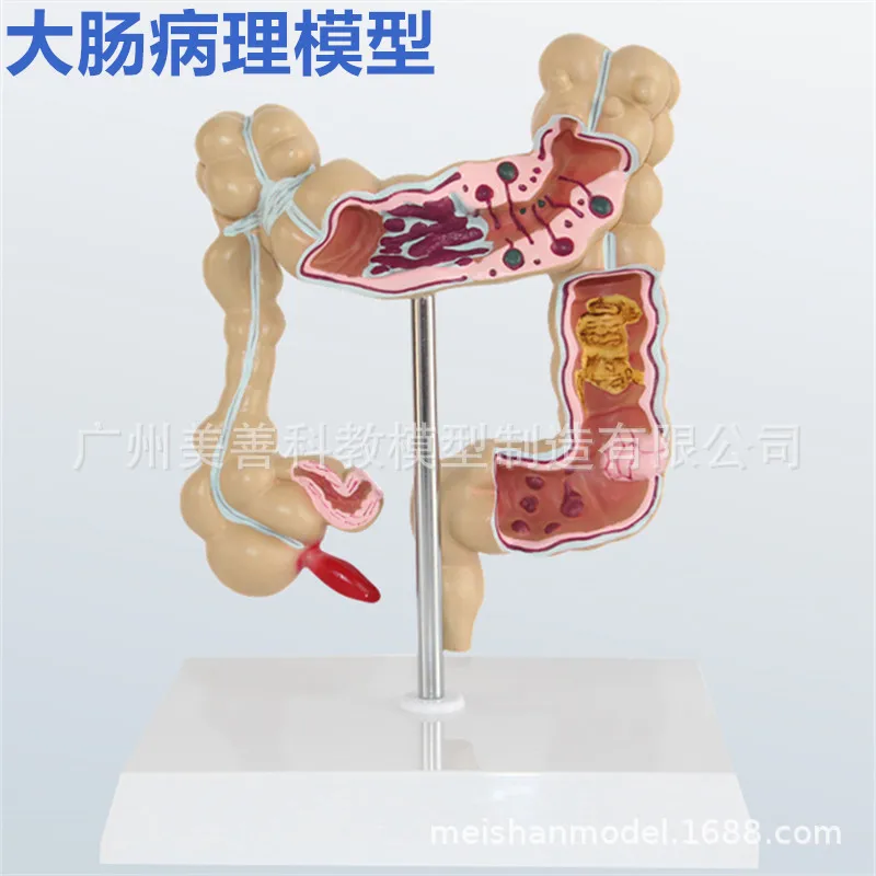 1/2 Life Size Human Rectal Pathology Colon Model Large Intestine Model Anorectal Anatomical Model Tools