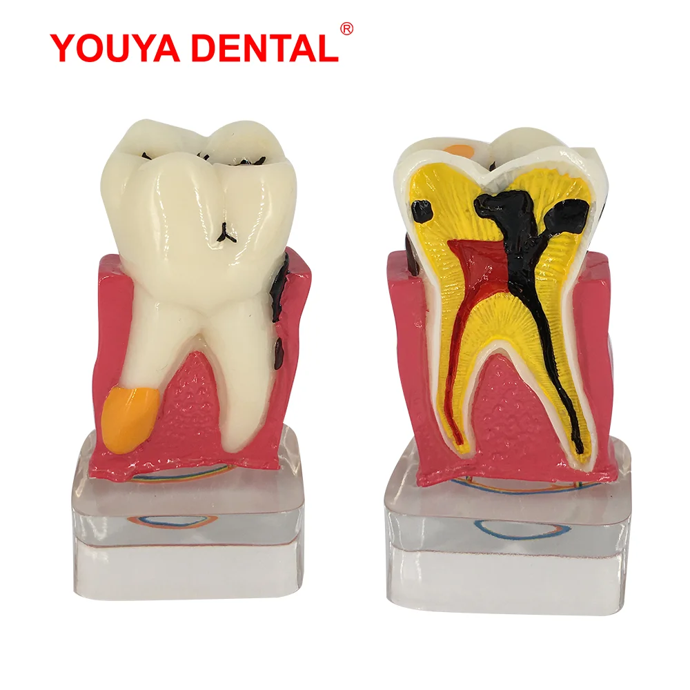 Dental Model Resin 4times Transparent Molar Anatomy Teeth Modeling With Nerves Medical Science Oral Dentist   Dentistry Products