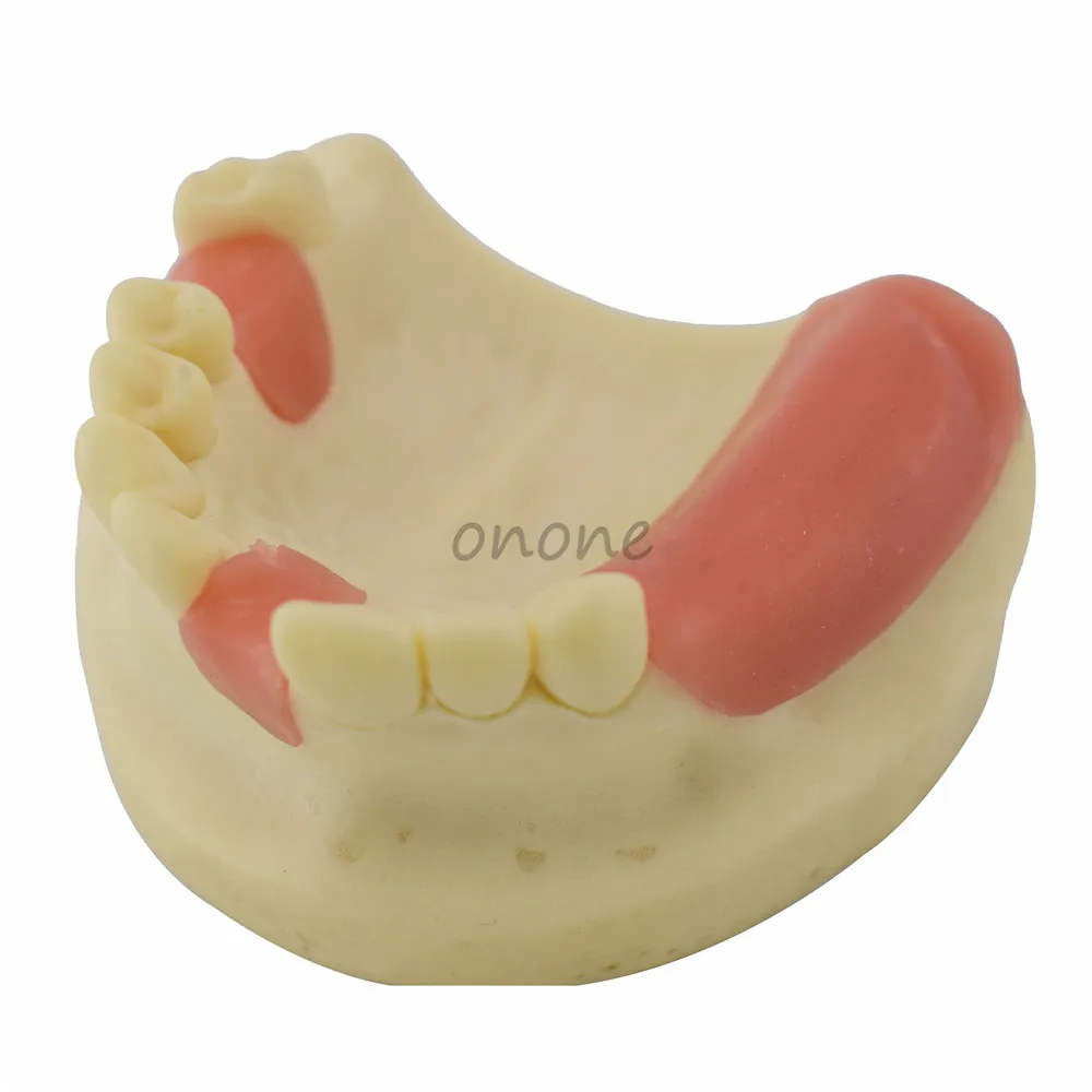 Maxillary Missing Tooth Model Bone Imitating Oral Teaching Aids Dental Implant Placement Exercise Prop