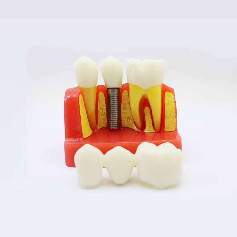 

4 Times Teeth Model Dental Implant Analysis Crown Bridge Demonstration Dental Teeth Model Dentist Tools Study Model