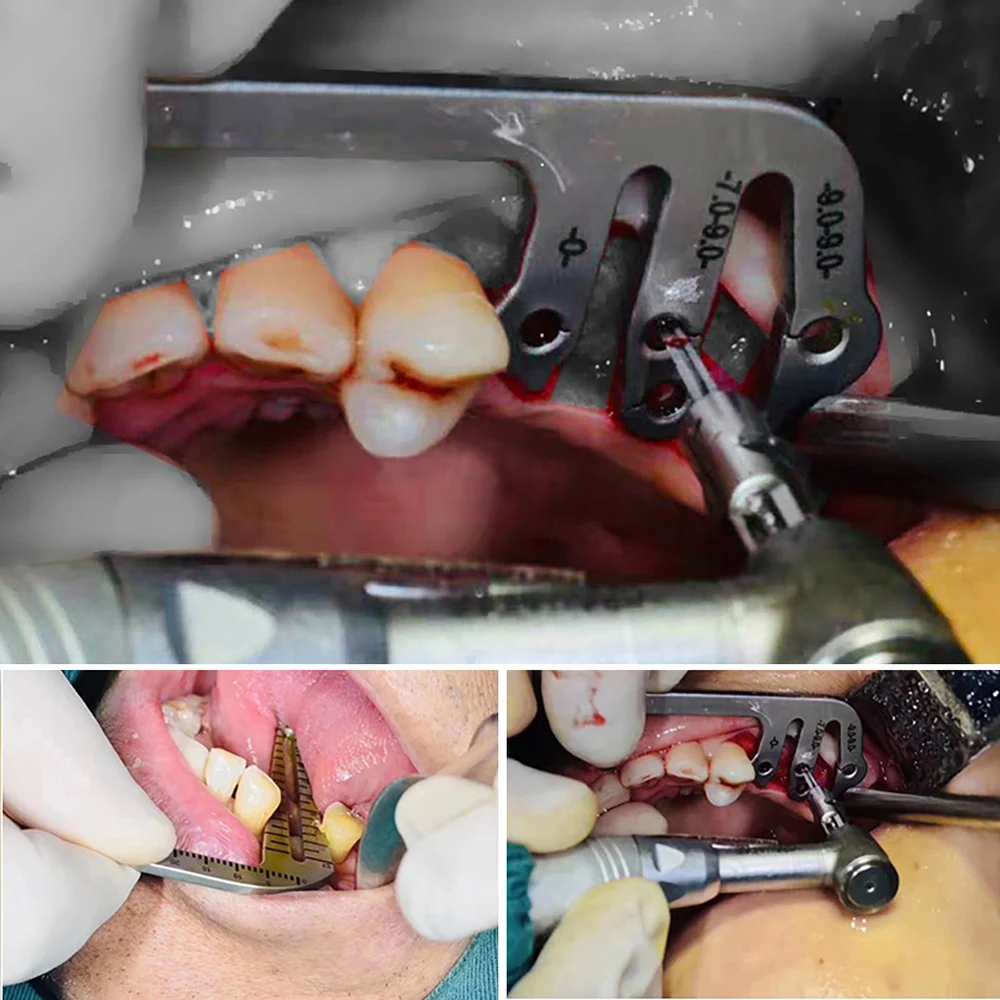 Implant stomatologiczny Instrument chirurgiczny linijka do pozycjonowania ustnego