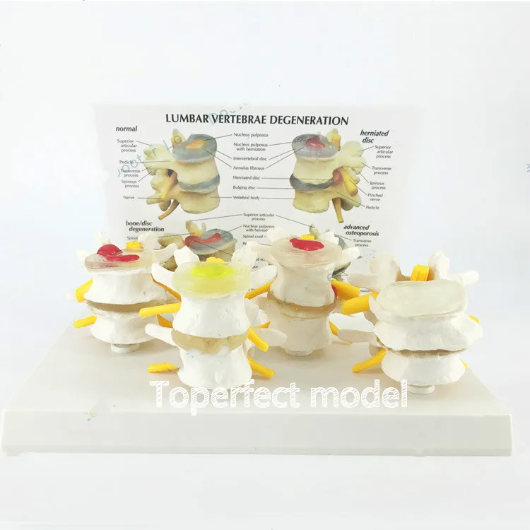 

Medical Normal Lumbar Spine Lesion Combined Anatomical Model Intervertebral Disc Pain Teaching Skeletal Model