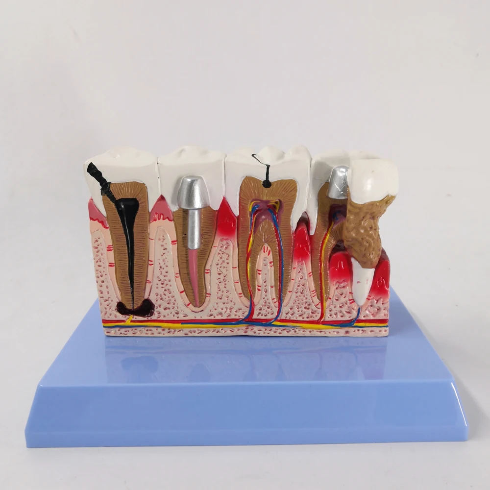 Dental Model | Human Body Anatomy Replica of Teeth w/Common Pathologies for Dentist Office Educational Tool