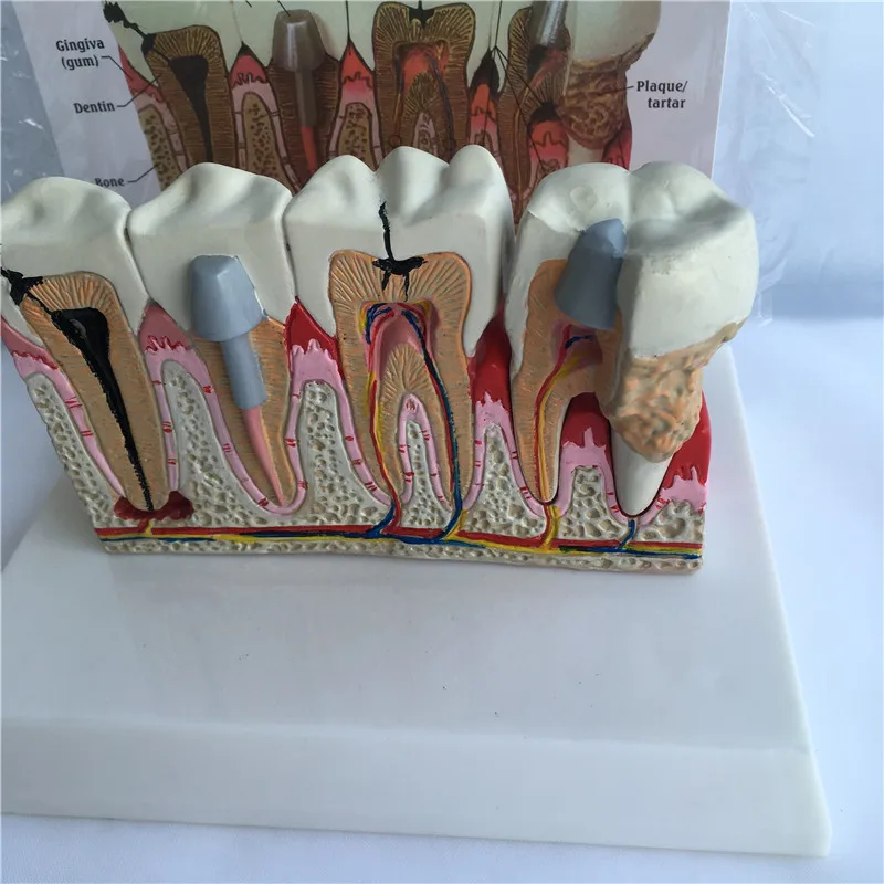 Human Tooth Common Pathologies Anatomy Model   Dental Model Medicine Teaching Instrument