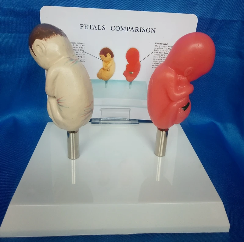 

Smoking Fetus and Normal Fetus Comparison Model Smoking Pathological Fetal Model Medical Teaching Model Smoking Baby Comparison