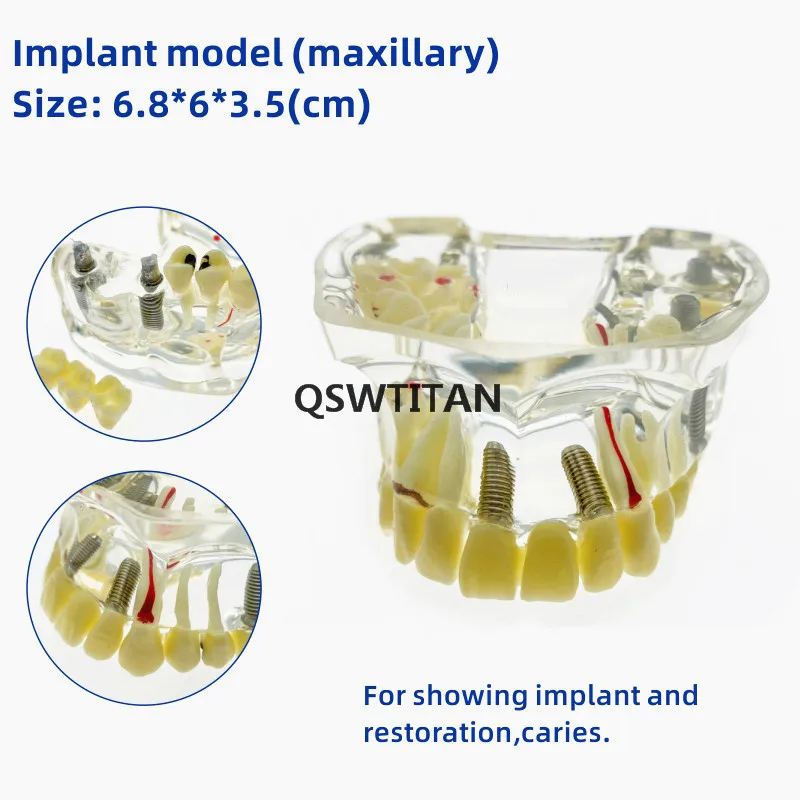 Model zębów z mostkiem i próchnicą górna szczęka dolna szczęka model zębów model implantu dentystycznego