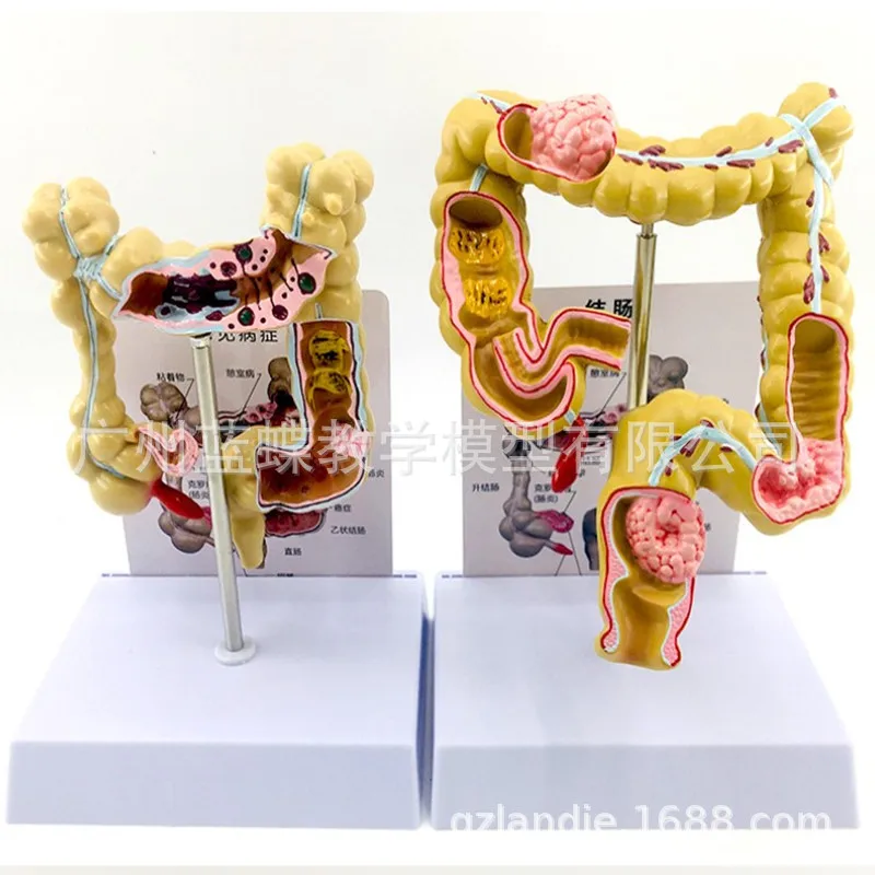 1/2 Life Size Human Rectal Pathology Colon Model Large Intestine Model Anorectal Anatomical Model Tools