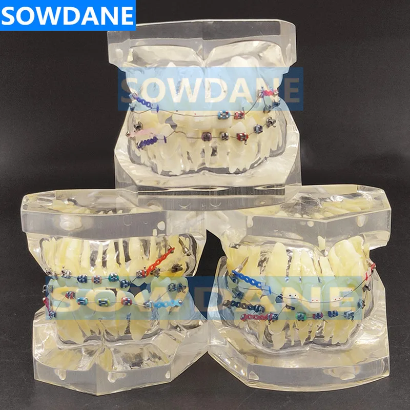 Transparent Dental Orthodontic Mallocclusion Model with Brackets Archwire buccal tube Tooth Extraction for Patient Communication