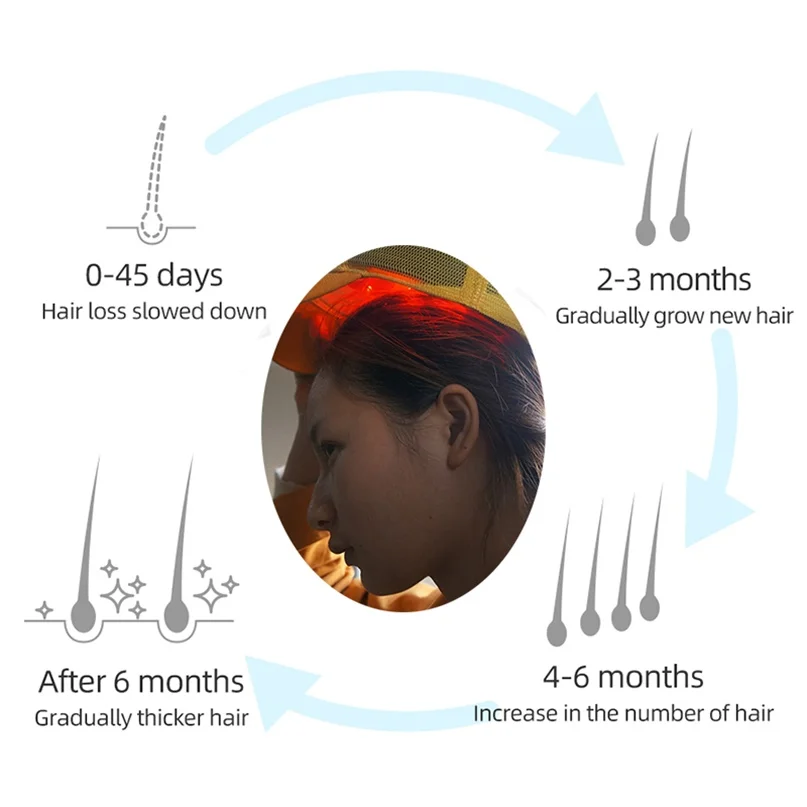 

Лазерная шапочка для роста волос 3-в-1 96 лучей для лечения истонченных волос и выпадения, домашнее устройство для терапии LLLT