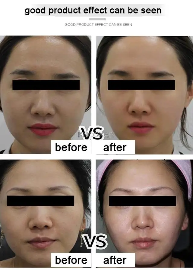 Appareil de massage facial Portable, appareil à ultrasons, Radar d'élimination des rides, sculpte la ligne, resserre la peau, machine à soulever le visage